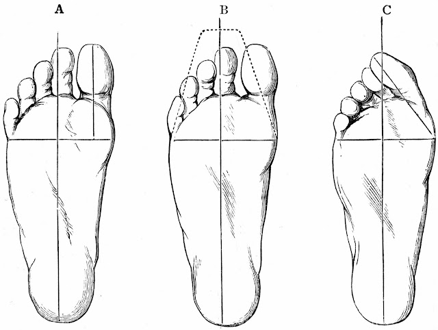 Проблемът със ширината на обувките – носенето на нормални обувки води до деформиране на ходилото и бунион